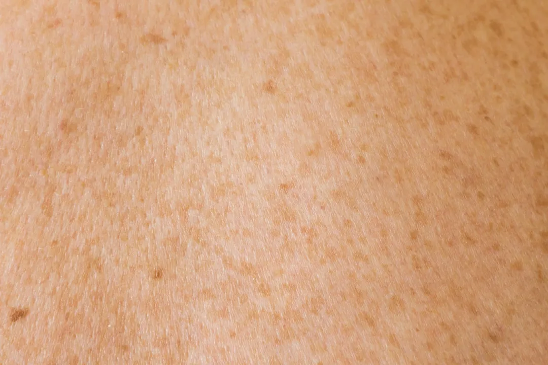 Um close -up das costas de uma pessoa com manchas marrons