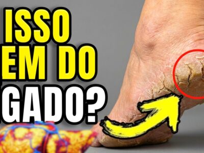 FÍGADO MORRENDO: O SINAL NO SEU PÉ QUE PODE SALVAR SUA VIDA!