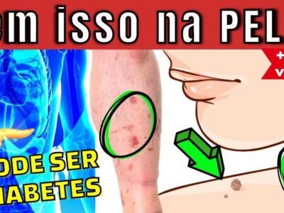 10 PRINCIPAIS SINAIS de DIABETES na PELE! (aparecem se você tem MUITO AÇÚCAR no sangue)