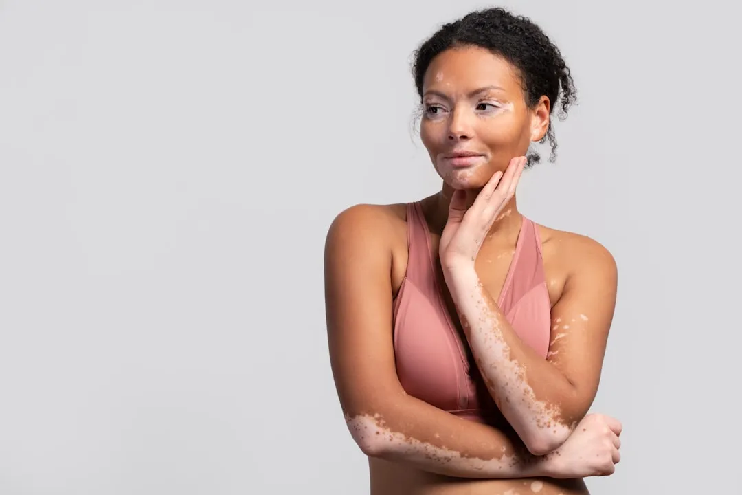 Doenças como o vitiligo mostram a profunda conexão entre o estado emocional e a saúde da pele. Uma mulher com vitiligo posa para um retrato.