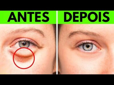 Livre-se das Bolsas nos Olhos com esses 17 remédios caseiros
