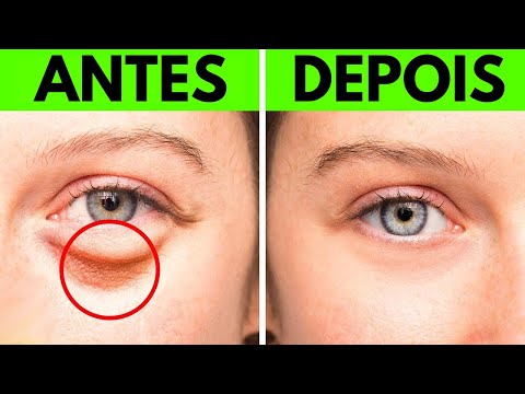 Livre-se das Bolsas nos Olhos com esses 17 remédios caseiros