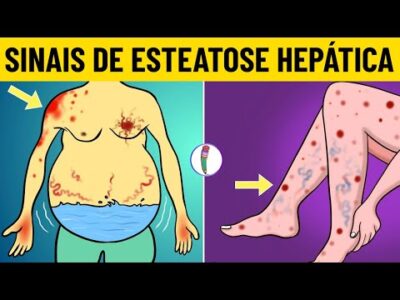 Sintomas de Esteatose Hepática | Sinais Precoces da Esteatose Hepática | Esteatose Não Alcoólica