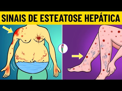 Sintomas de Esteatose Hepática | Sinais Precoces da Esteatose Hepática | Esteatose Não Alcoólica