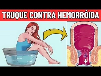 6 Maneiras Naturais de Tratar Hemorroidas de Forma Rápida e Eficaz | Tratar Hemorroidas em Casa