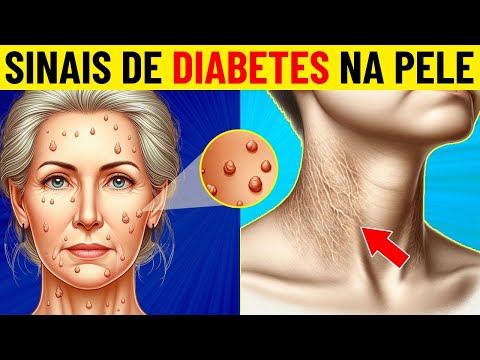 8 sinais de diabetes na pele que você não deve ignorar!