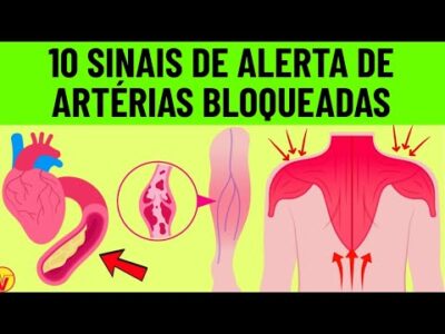 10 sinais de alerta de artérias cardíacas bloqueadas nas pernas e nos pés