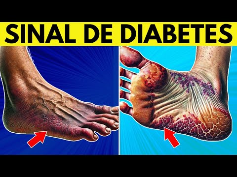 10 sinais de que seus pés indicam diabetes!
