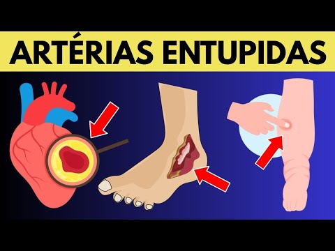 10 Sinais de Alerta de Artérias Cardíacas Bloqueadas nas Pernas e Pés (Não Ignore Esses Sinais)
