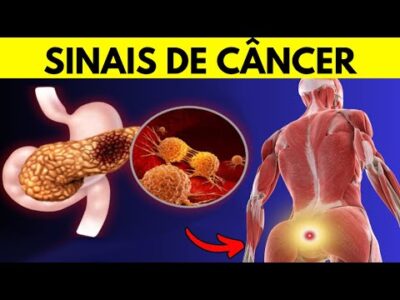 6 sintomas de CÂNCER DE PÂNCREAS que vão CHOCAR VOCÊ | Sinais de alerta críticos