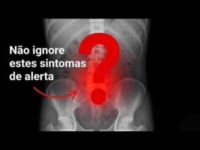 7 sinais de alerta de diverticulite que a maioria dos médicos ignora