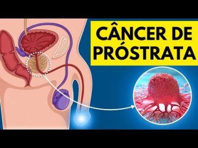 Sinais de Câncer de Próstata que Você Nunca Deve Ignorar