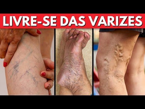 9 maneiras naturais de se livrar de varizes e aumentar o fluxo sanguíneo