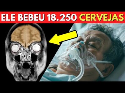 Um Homem Destruiu o Cérebro ao beber 50 Cervejas Todo Dia Durante 6 Semanas